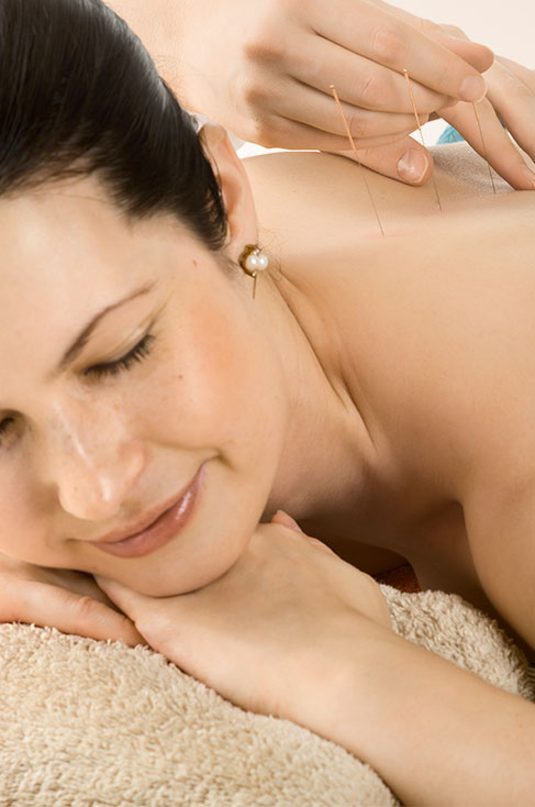 Acupuncture