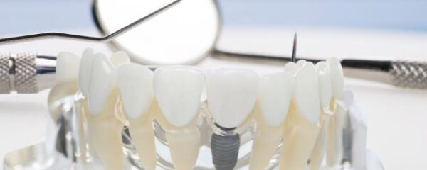 entretenir un implant dentaire